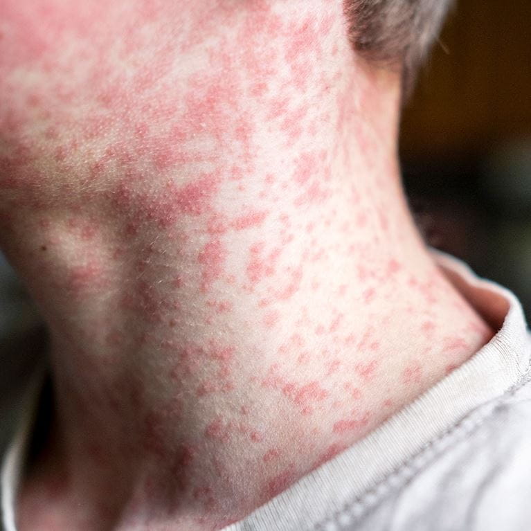 Image of child with measles on neck.