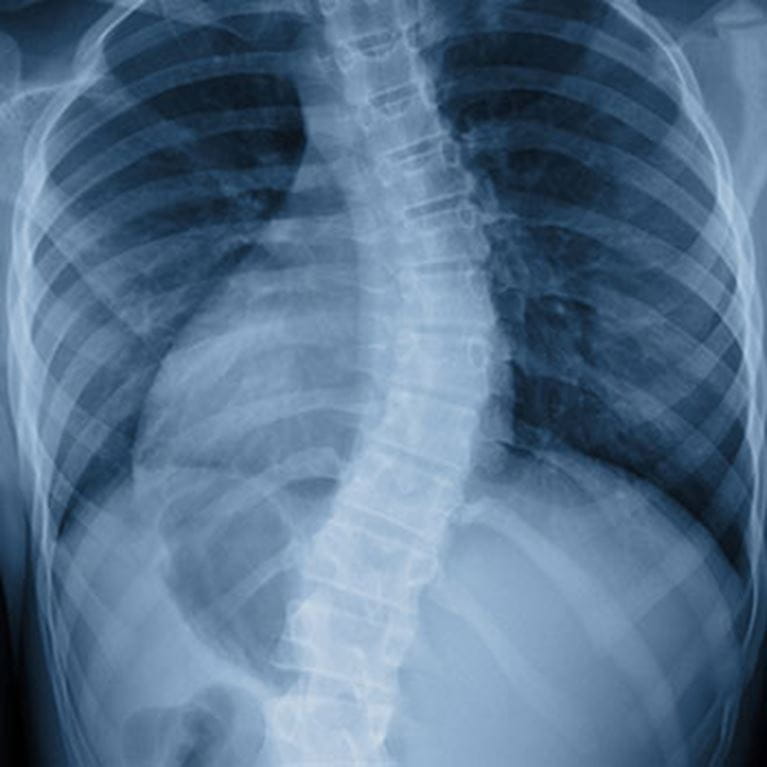 X-ray of curved spine.