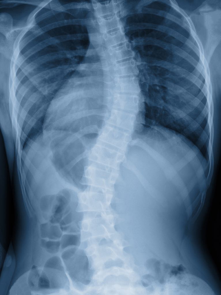 Scoliosis X-ray