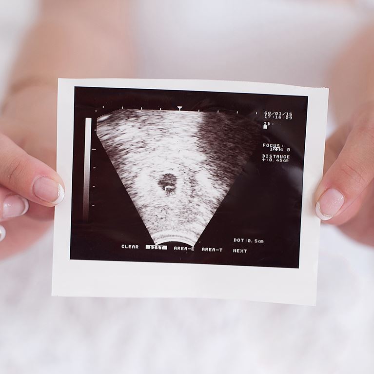 Black and white picture of prenatal ultrasound.