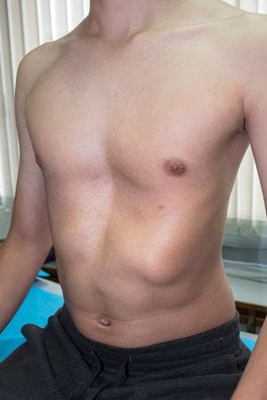 Image of young male with pectus excavatum (sunken chest)