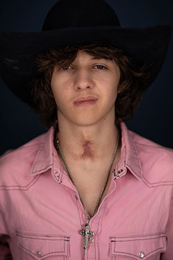 Arkansas Children's teenage ENT patient with trach scar.