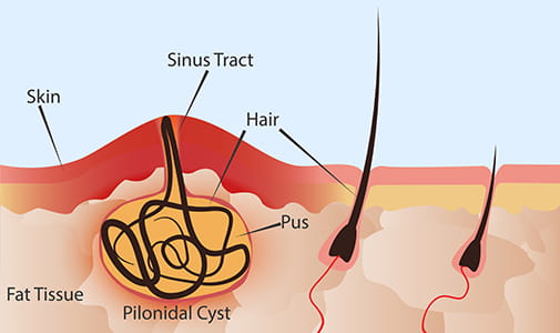 Pilonidal cyst illustration